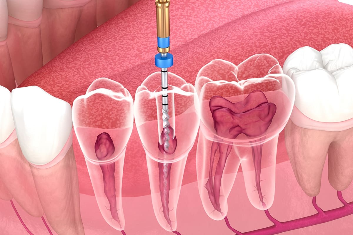 Endodonzia Endodonzia